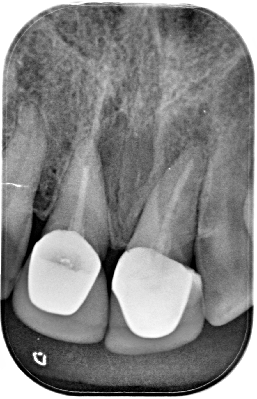 quistes dentarios