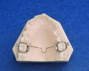 Mantenedores de espacio dental | Dentista Legazpi | Clínica dental infantil | Mejores implantes dentales