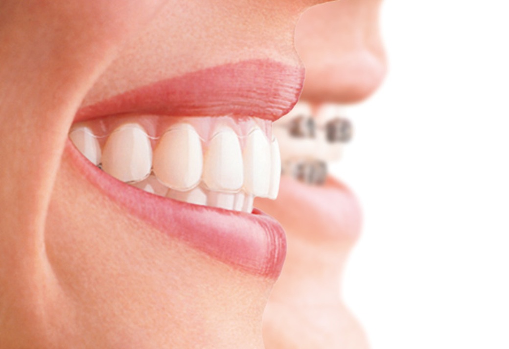 preguntas frecuentes acerca de la ortodoncia invisible