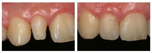 Carillas de composite antes y después | Carillas dentales | Clínica dental Arganzuela | Carillas estéticas