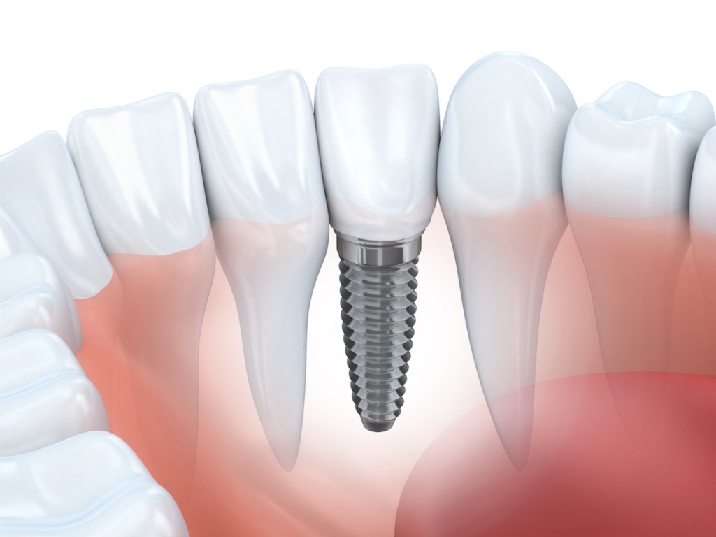 ¡Cuánto dura un implante dental?