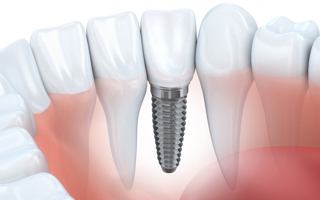 Causas de rechazo de los implantes dentales