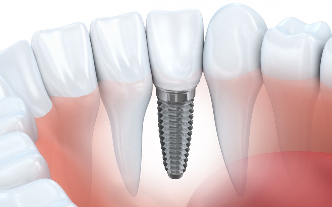 ¿Cuánto dura un implante dental?