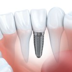 Causas de rechazo de los implantes dentales