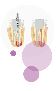 endodoncia