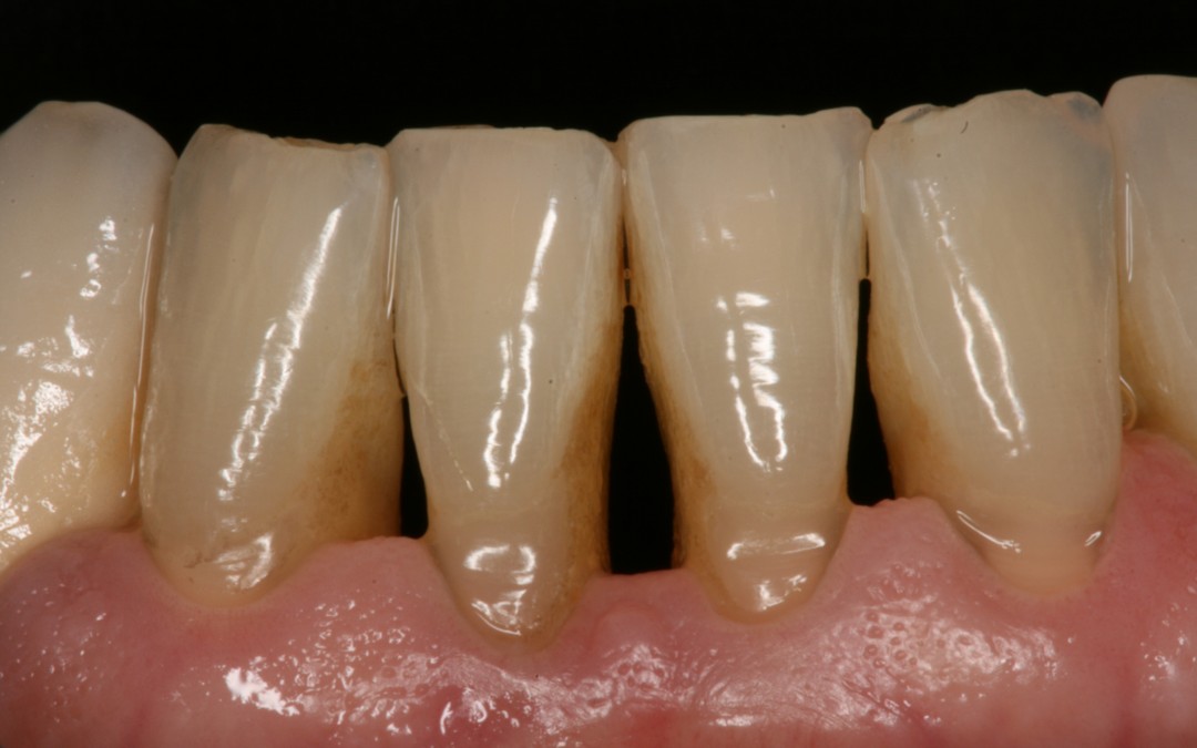 Periodontitis Crónica