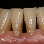 Periodontitis Crónica