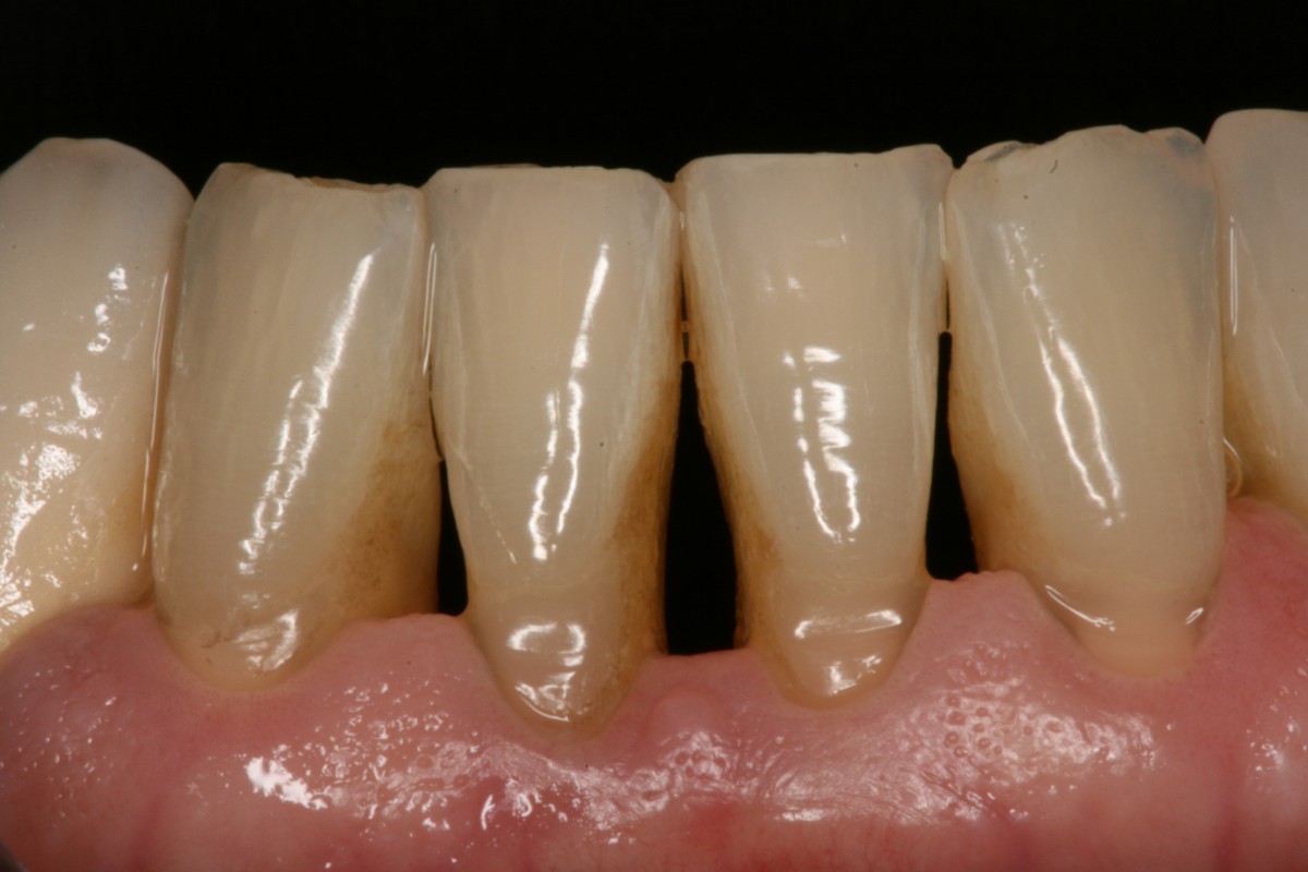 cirugía periodontal