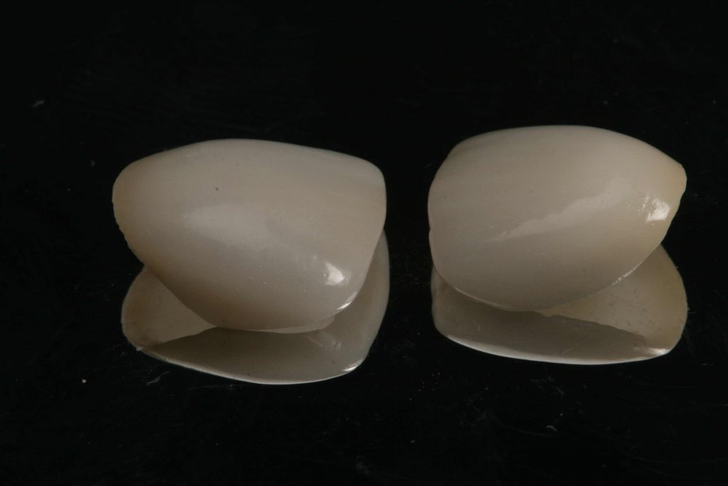 carillas de porcelana | Dentista Usera | Odontología estética | Prótesis dental