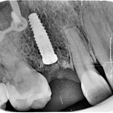 implantes de carga inmediata