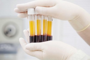 PLASMA RICO EN PLAQUETAS | ortodoncia invisible con alineadores | Clínica dental Larrañaga | Ortodoncia transparente