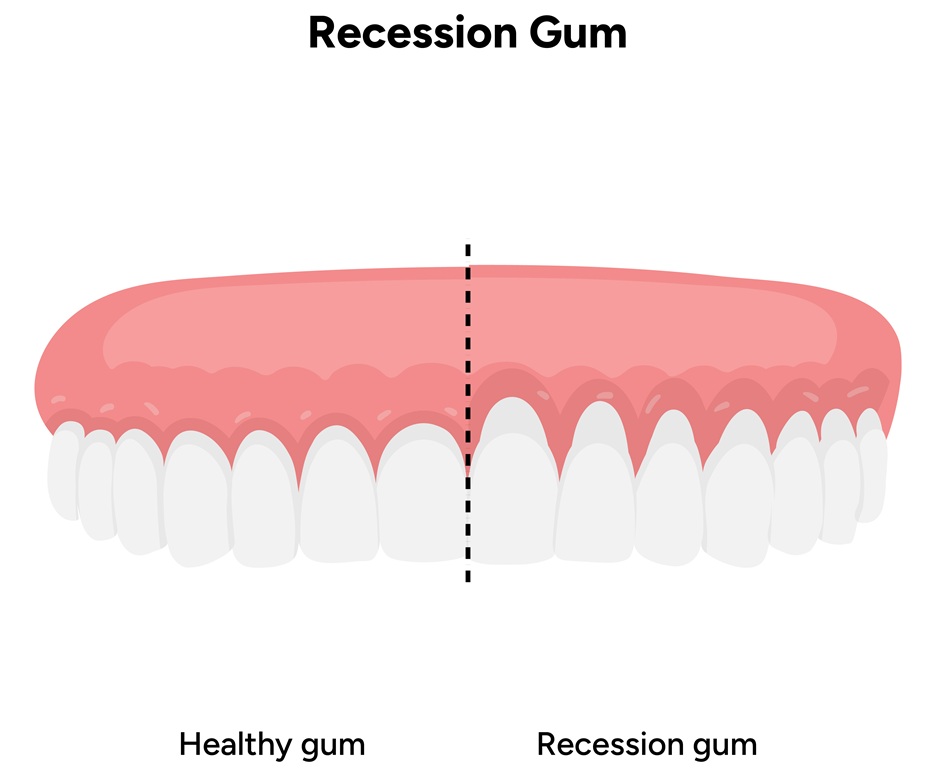 Esquema de que es una | Recesión de Encias | Salud Bucodental | Problemas Dentales