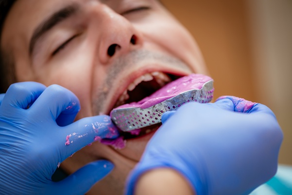 sacando molde dental para hacer un aparato de descarga | Bruxismo | Dentista Madrid Río| Clínica Dental