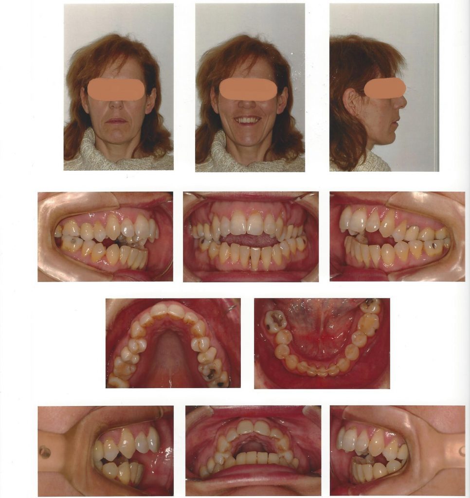 Diagnóstico En Ortodoncia Clinica Dental Larrañaga Diagnóstico En Ortodoncia Clinica Dental Larrañaga