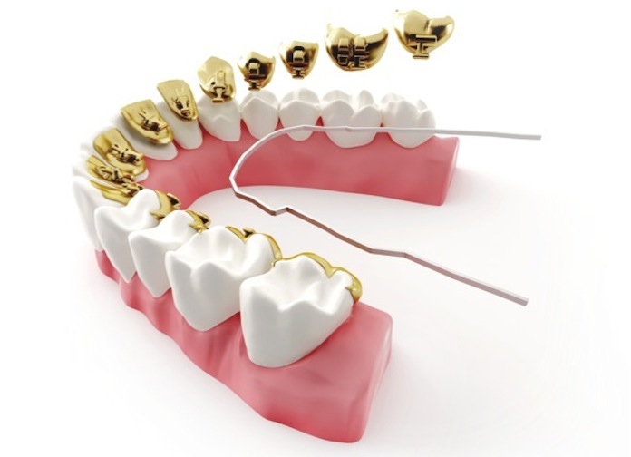 Tipos_de_Brackets_Brackets_Linguales