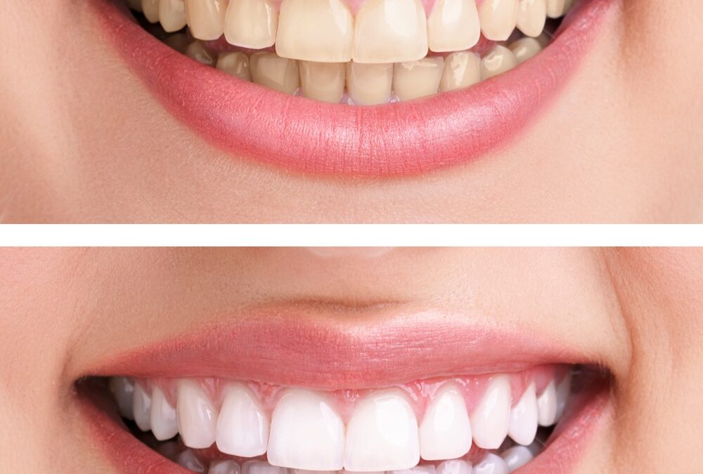 antes y despues blanqueamiento dental