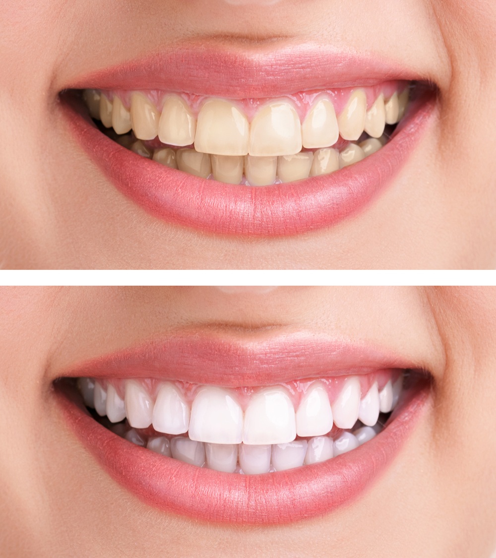 Sonrisa del antes y después de un blanqueamiento | blanqueamiento dental | Estética dental | Clinica dental Madrid | Clinica dental Larrañaga