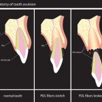 Avulsión Dentaria