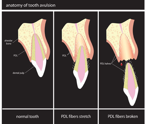 avulsion dentaria