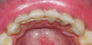 retenedores fijos | Apnea del sueño | Dentista Madrid | Carillas de porcelana