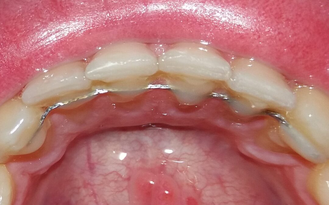 retenedores de ortodoncia