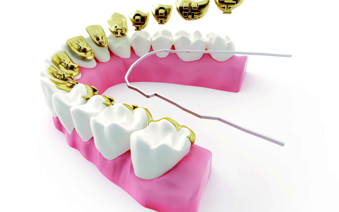 brackets linguales