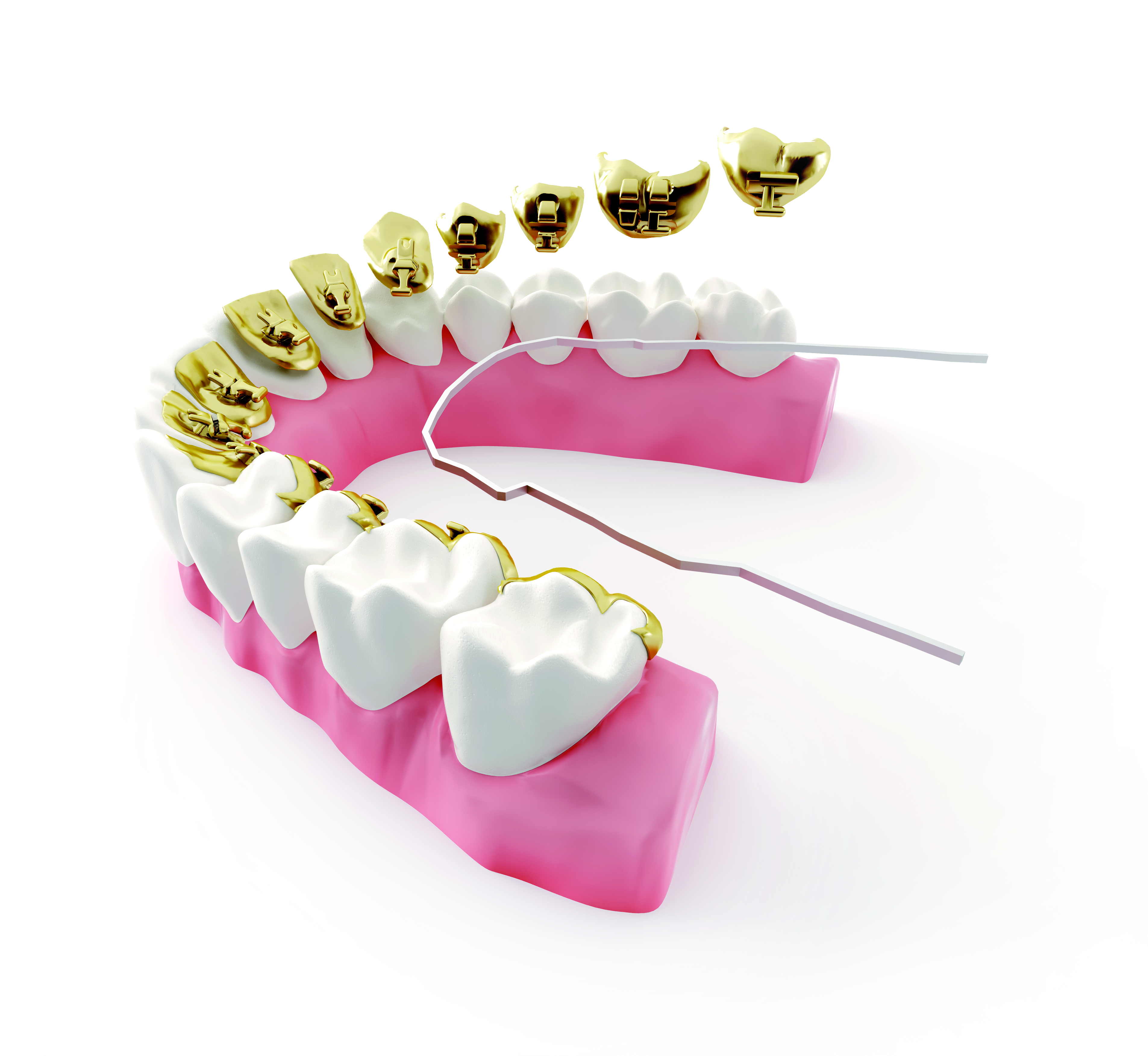 ortodoncia lingual desventajas