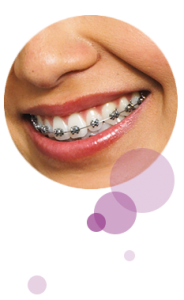 Imagen de dentadura con brackets | Dentista infantil | Odontología infantil | Ortodoncia invisible