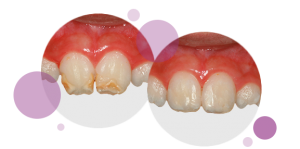 empastes estéticos | Carillas dientes | Carillas de porcelana | Carillas dientes
