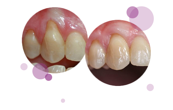 caso-periodoncia-2