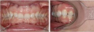 Imagen de dientes | Apnea del sueño | Dentista Madrid | Carillas de porcelana