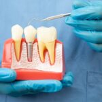 Implantes dentales: ventajas y cuidados