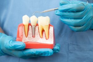 Dentista mostrando maqueta de un implante dental | Estética Dental | Implante Dental | Dentista Arganzuela