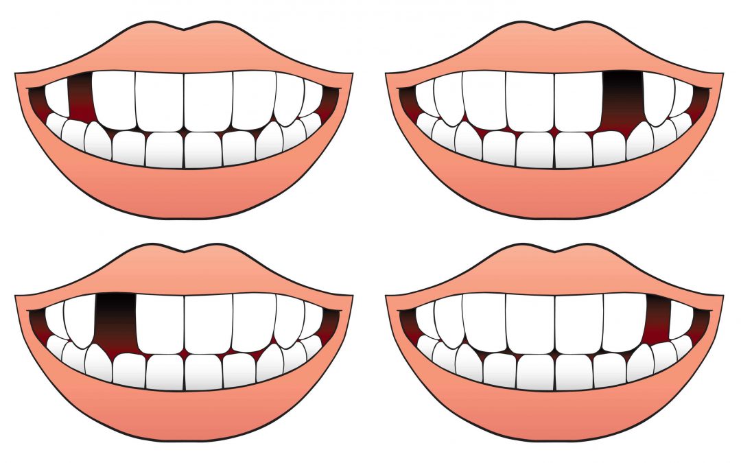 Cómo reponer un diente perdido