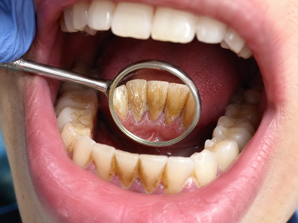 Boca llena de sarro | Dolor de Encías | Salud Bucodental | Clínica Dental en Madrid Río