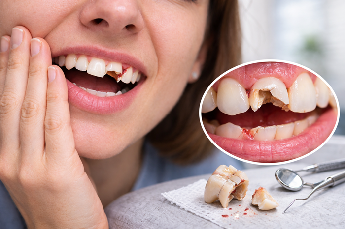 Dientes rotos o fracturados: qué hacer y cómo puede ayudarte tu dentista en Madrid