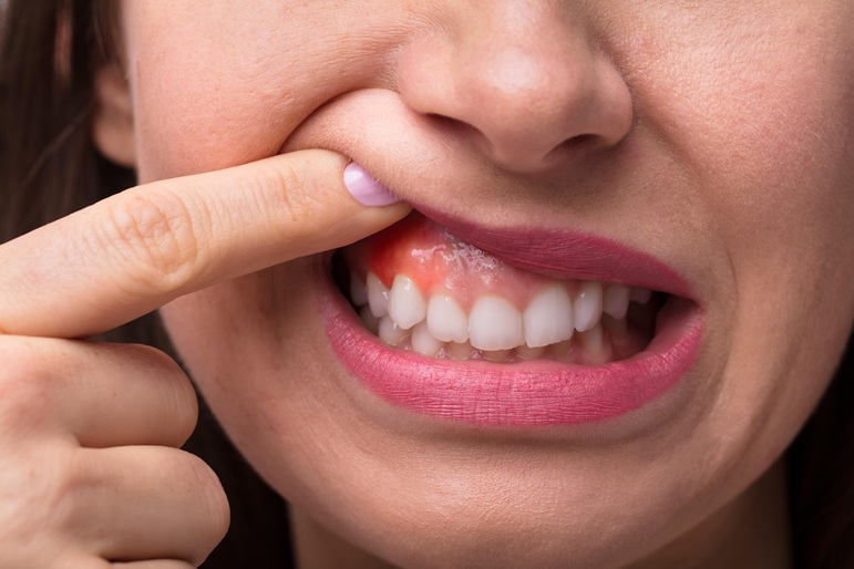 Dolor de encías: causas habituales y cuándo pedir una revisión dental