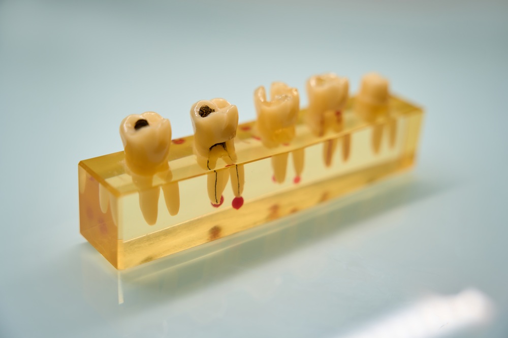 molde de dientes con caries | Fistula Dental | Salud Bucodental | Clinica Dental Larrañaga