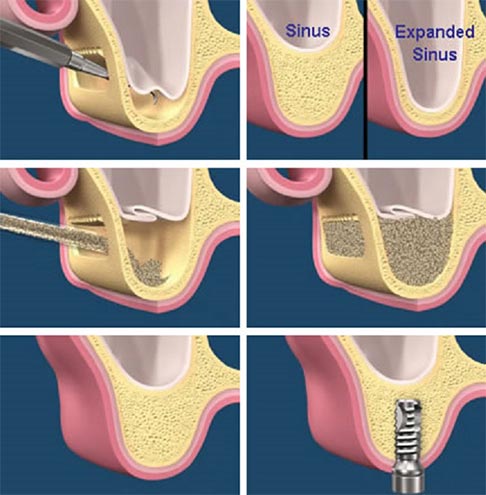 elevacion-seno-2