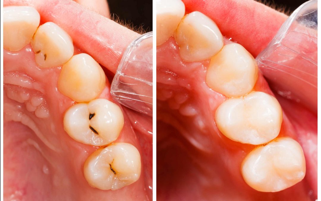 Exponer Cámara riñones Empastes estéticos - Odontología conservadora - Clinica Dental Larrañaga