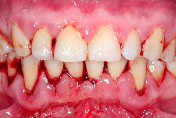 Encías que sangran: causas frecuentes y cuándo acudir al dentista en Madrid