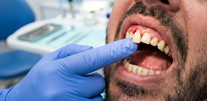 Paciente con la boca abierta donde se ve diente con encía retraída | Diente Definitivo se Mueve | Clínica Dental Arganzuela