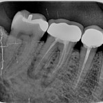 Endodoncia mal hecha