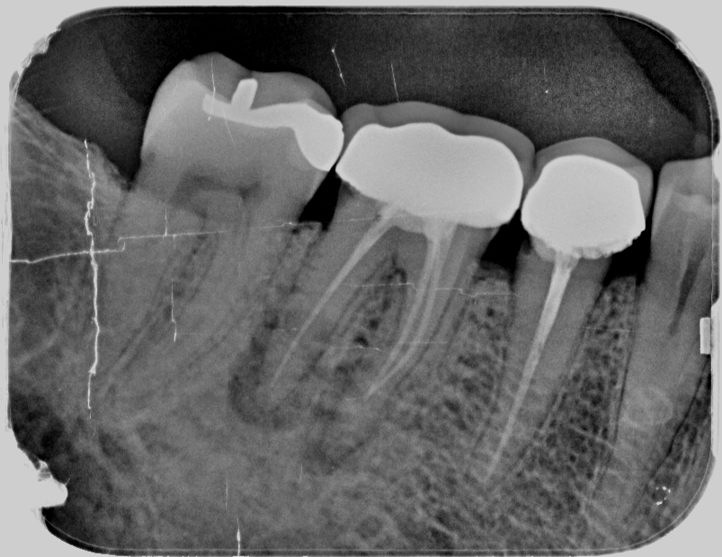 Endodoncia mal hecha