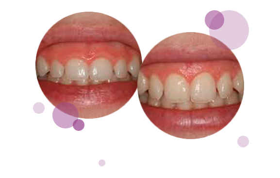 estetica-de-las-encias-ejemplo-de-sonrisa-gingival