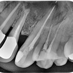 Quistes dentarios. Tratamiento