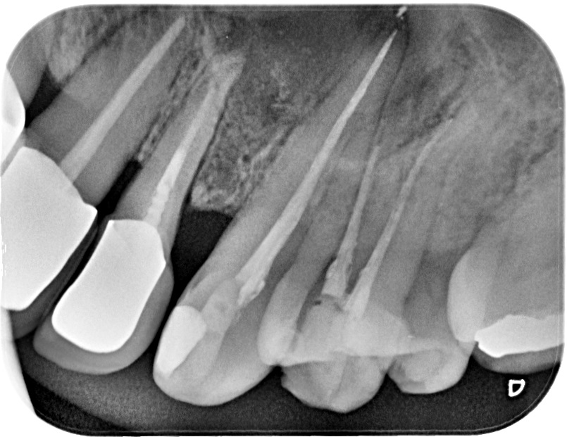 Quistes dentarios. Tratamiento