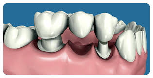 Prótesis Dental Fija Dentosoportada