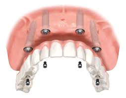 Prótesis Dental Fija Implantosoportada