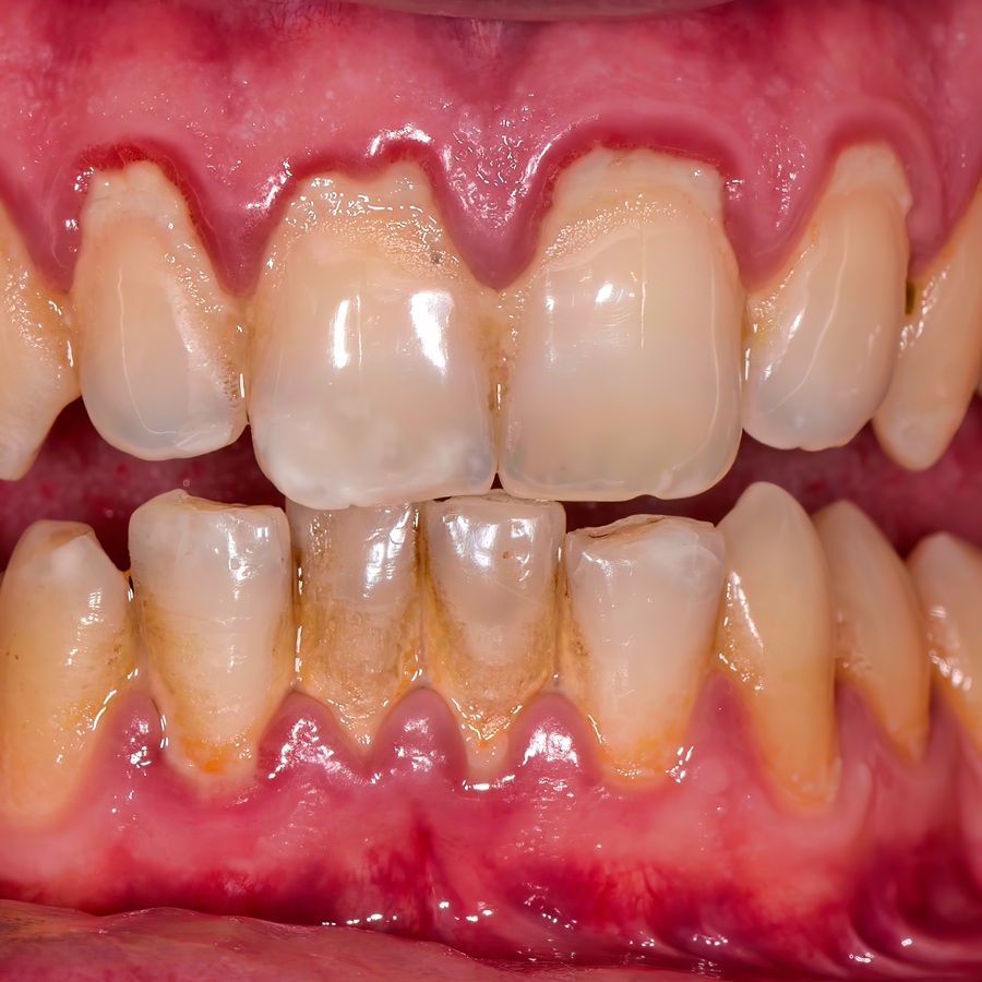 dientes con sarro, placas bacterianas | Recesión de Encias | Salud Bucodental | Problemas Dentales